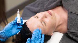 Chemical Peels