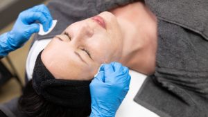 Chemical Peels
